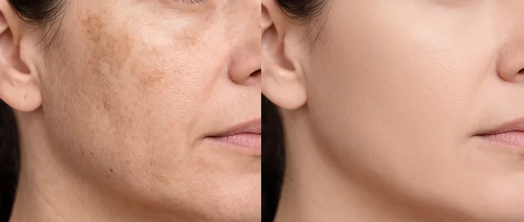 Antes e depois: O contorno cede e o rosto muda de forma no fim do dia.